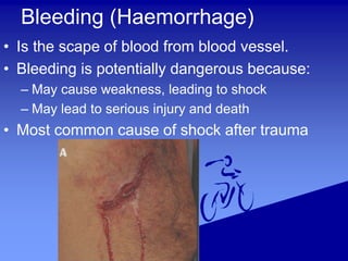 Bleeding (Haemorrhage)
• Is the scape of blood from blood vessel.
• Bleeding is potentially dangerous because:
– May cause weakness, leading to shock
– May lead to serious injury and death
• Most common cause of shock after trauma
 