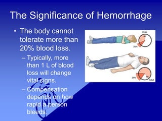 The Significance of Hemorrhage
• The body cannot
tolerate more than
20% blood loss.
– Typically, more
than 1 L of blood
loss will change
vital signs.
– Compensation
depends on how
rapid a person
bleeds.
 