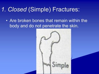 1. Closed (Simple) Fractures:
• Are broken bones that remain within the
body and do not penetrate the skin.
 
