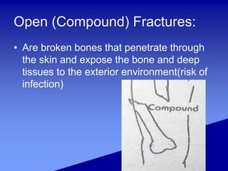 Open (Compound) Fractures:
• Are broken bones that penetrate through
the skin and expose the bone and deep
tissues to the exterior environment(risk of
infection)
 