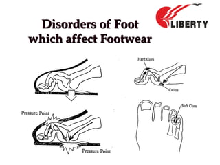 Disorders of FootDisorders of Foot
which affect Footwearwhich affect Footwear
 
