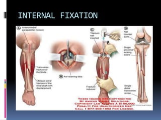 Basic fracture management | PPTX