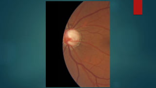 Basic fundoscopy | PPTX