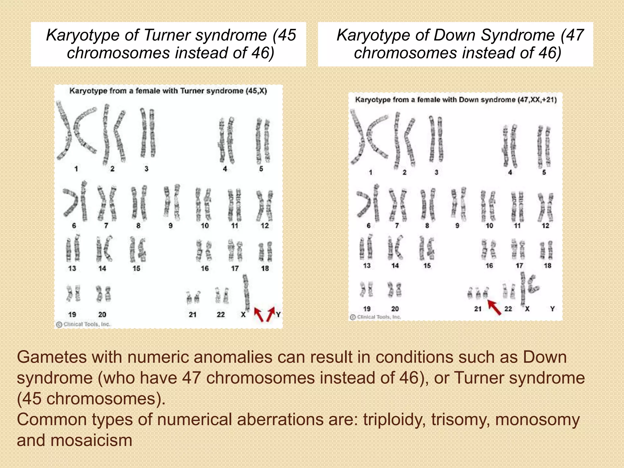 Gametes with numeric anomalies can result in conditions such as Down
syndrome (who have 47 chromosomes instead of 46), or Turner syndrome
(45 chromosomes).
Common types of numerical aberrations are: triploidy, trisomy, monosomy
and mosaicism
Karyotype of Turner syndrome (45
chromosomes instead of 46)
Karyotype of Down Syndrome (47
chromosomes instead of 46)
 