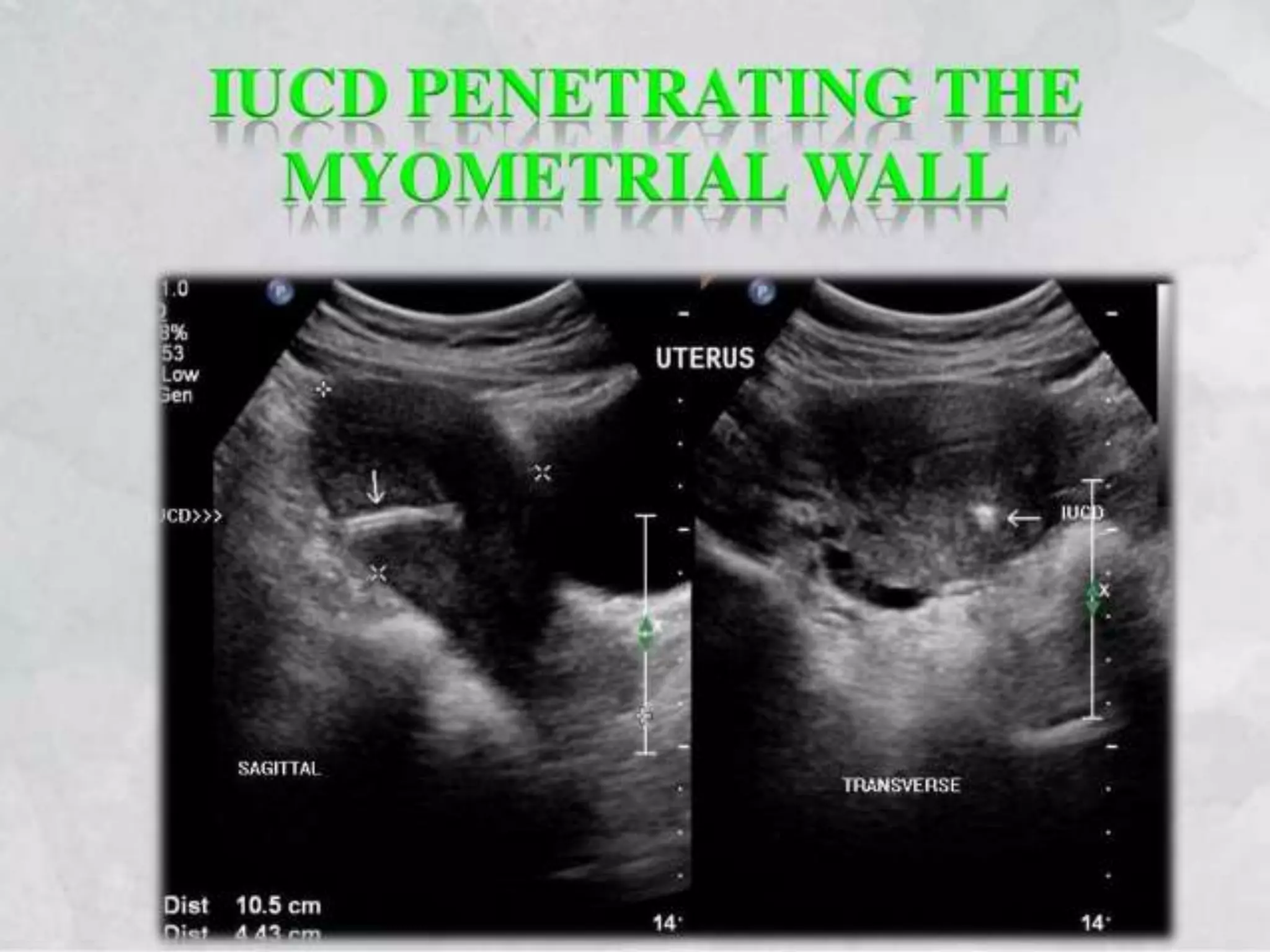 Basic gynae ultrasound | PPTX