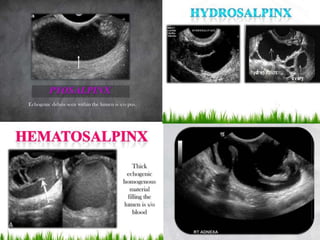 Basic gynae ultrasound