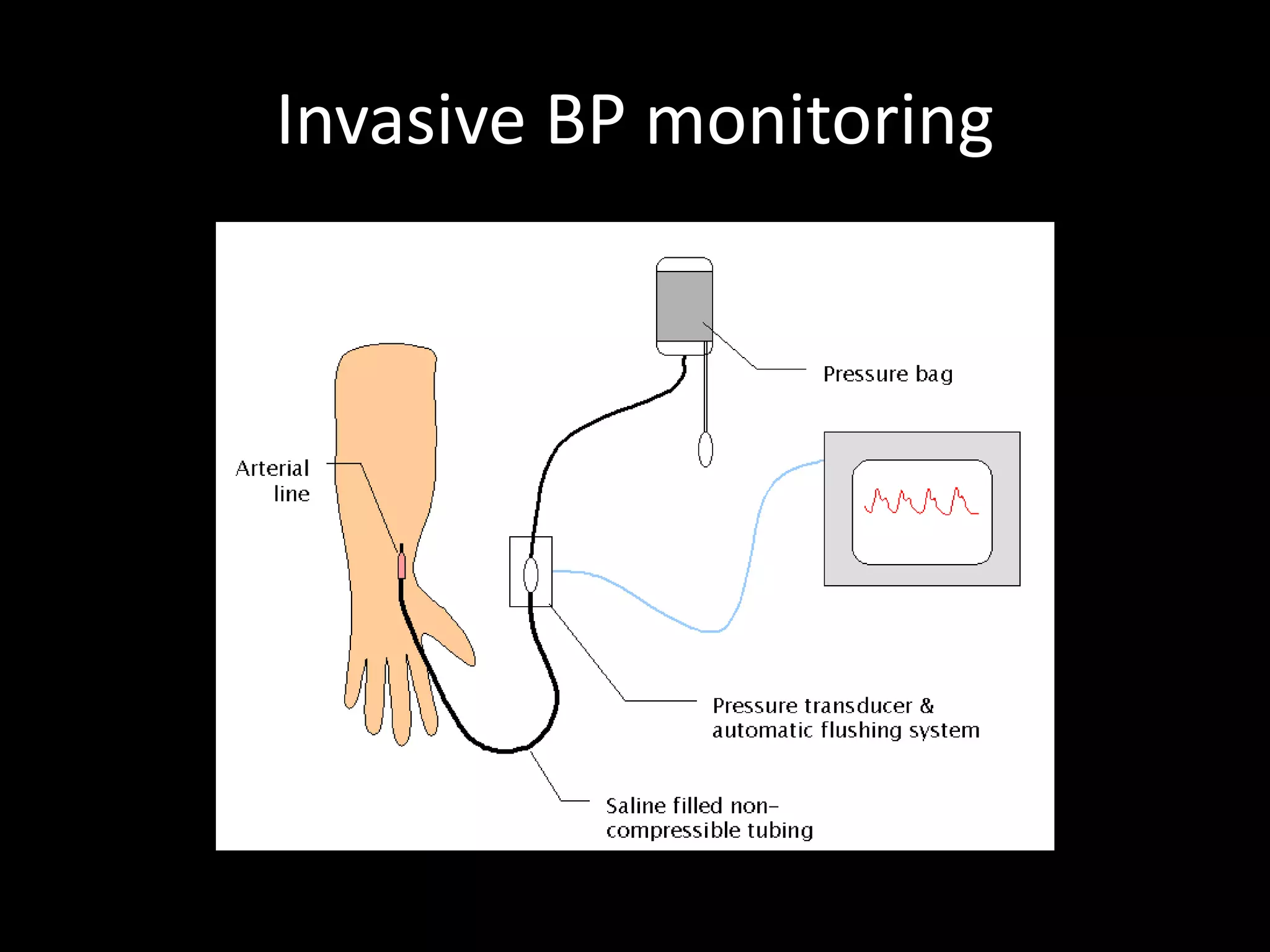 Invasive BP monitoring
 