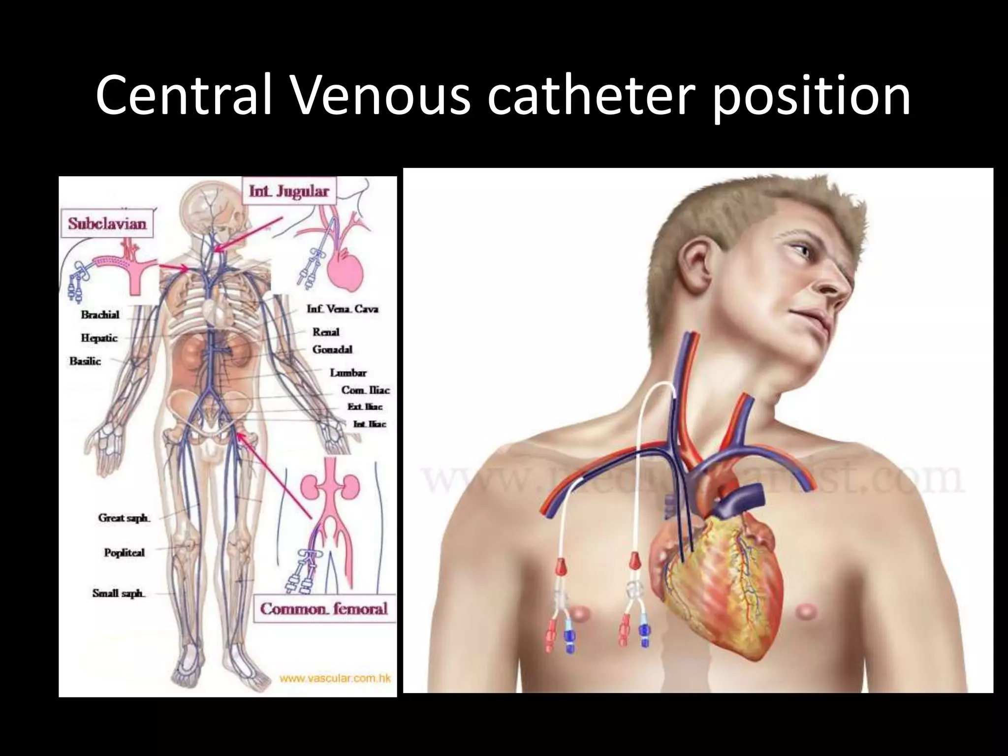 Central Venous catheter position
 