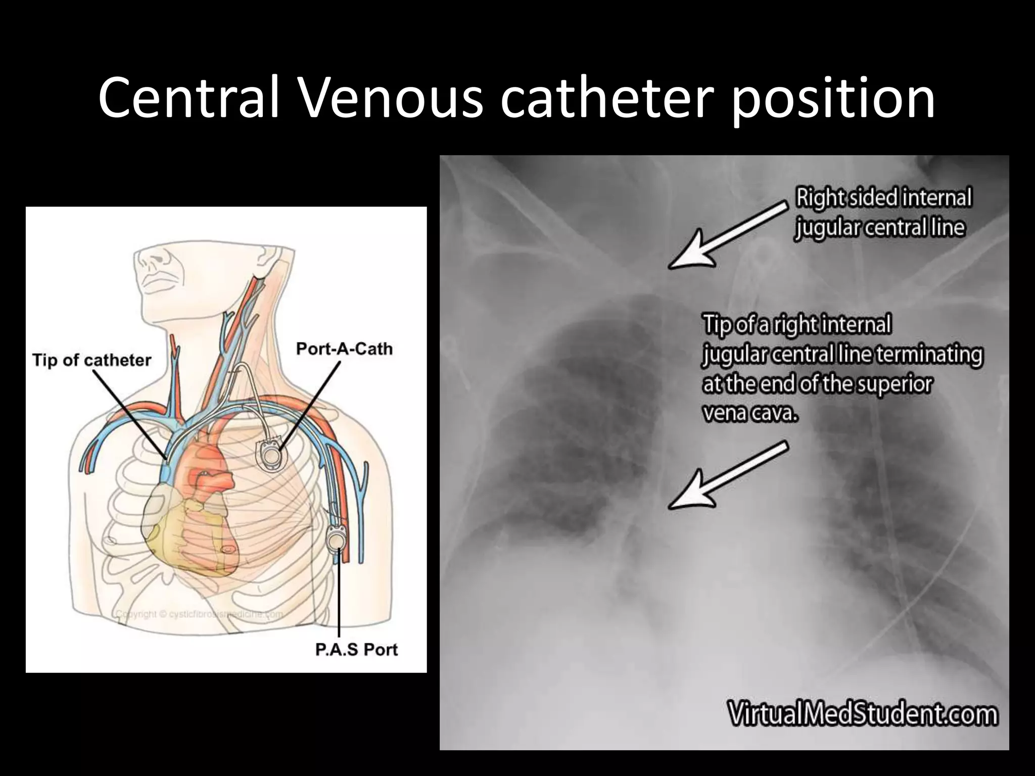 Central Venous catheter position
 