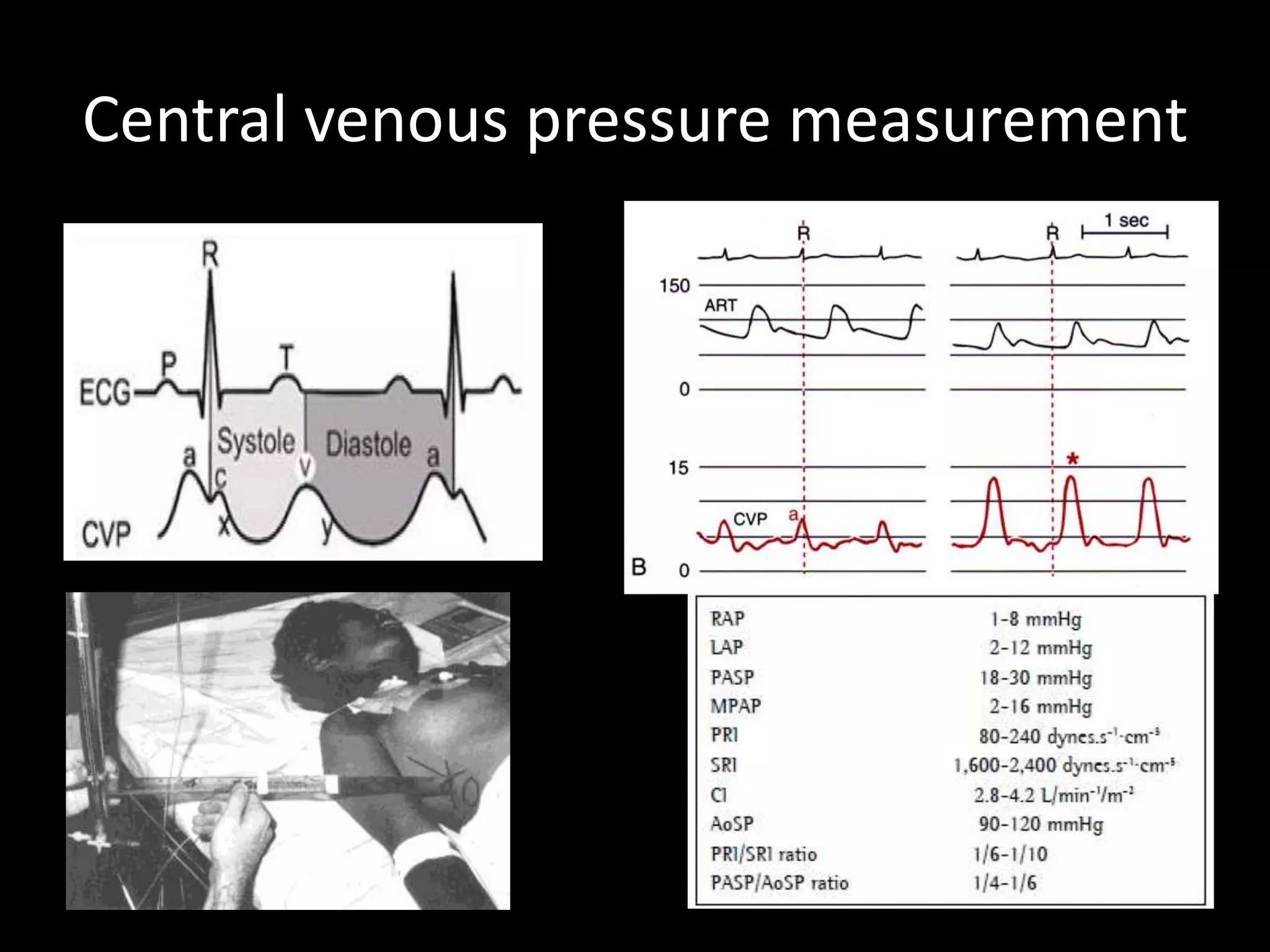 Central venous pressure measurement
 