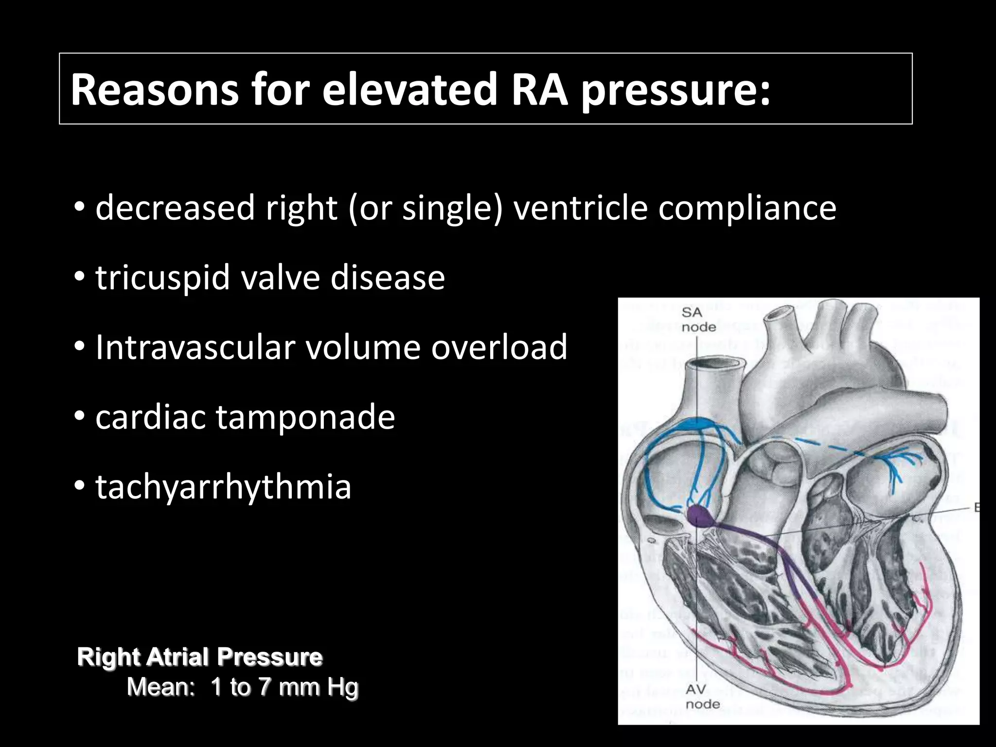 Reasons for elevated RA pressure:
• decreased right (or single) ventricle compliance
• tricuspid valve disease
• Intravascular volume overload
• cardiac tamponade
• tachyarrhythmia
Right Atrial Pressure
Mean: 1 to 7 mm Hg
 