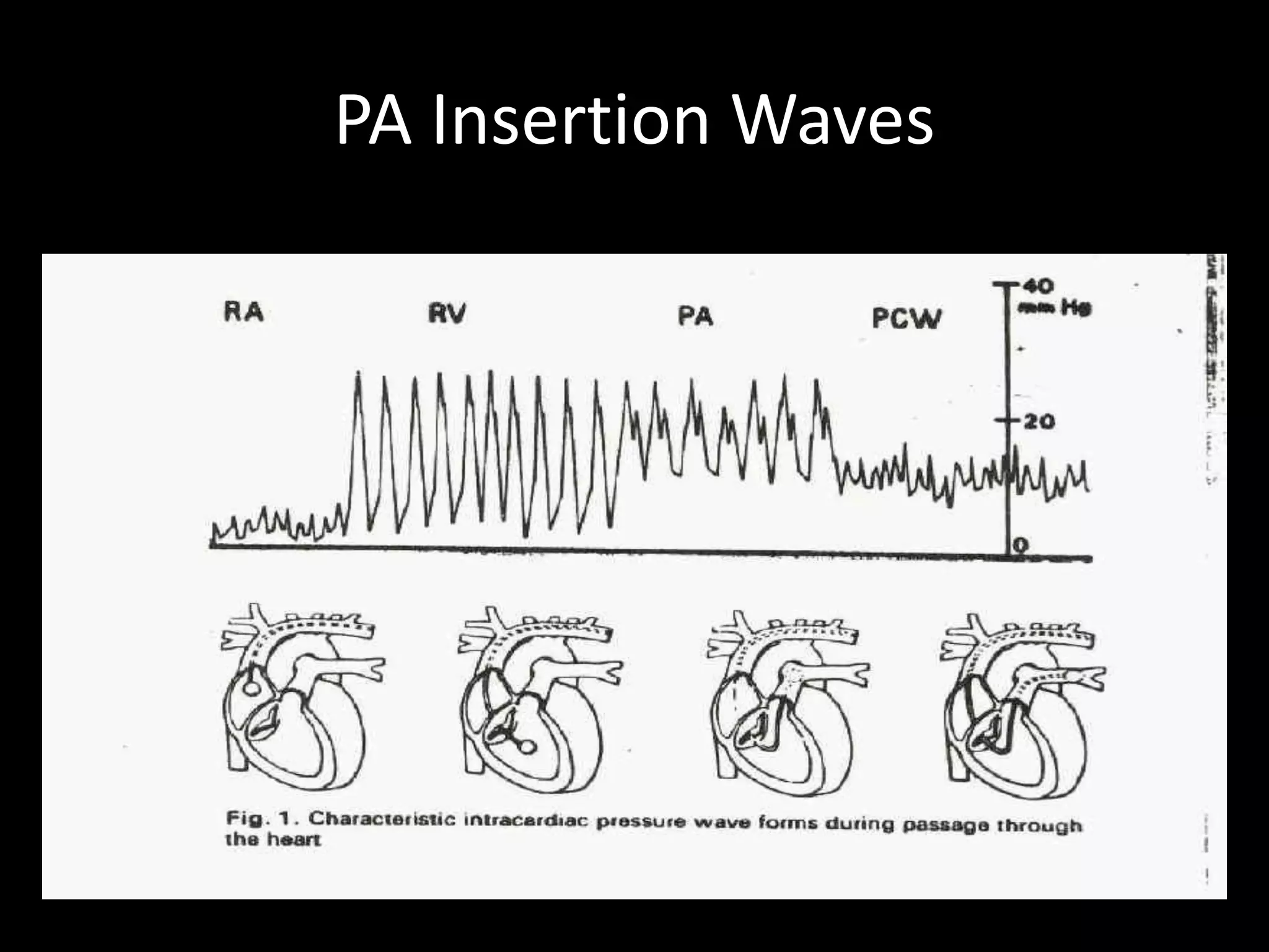PA Insertion Waves
 