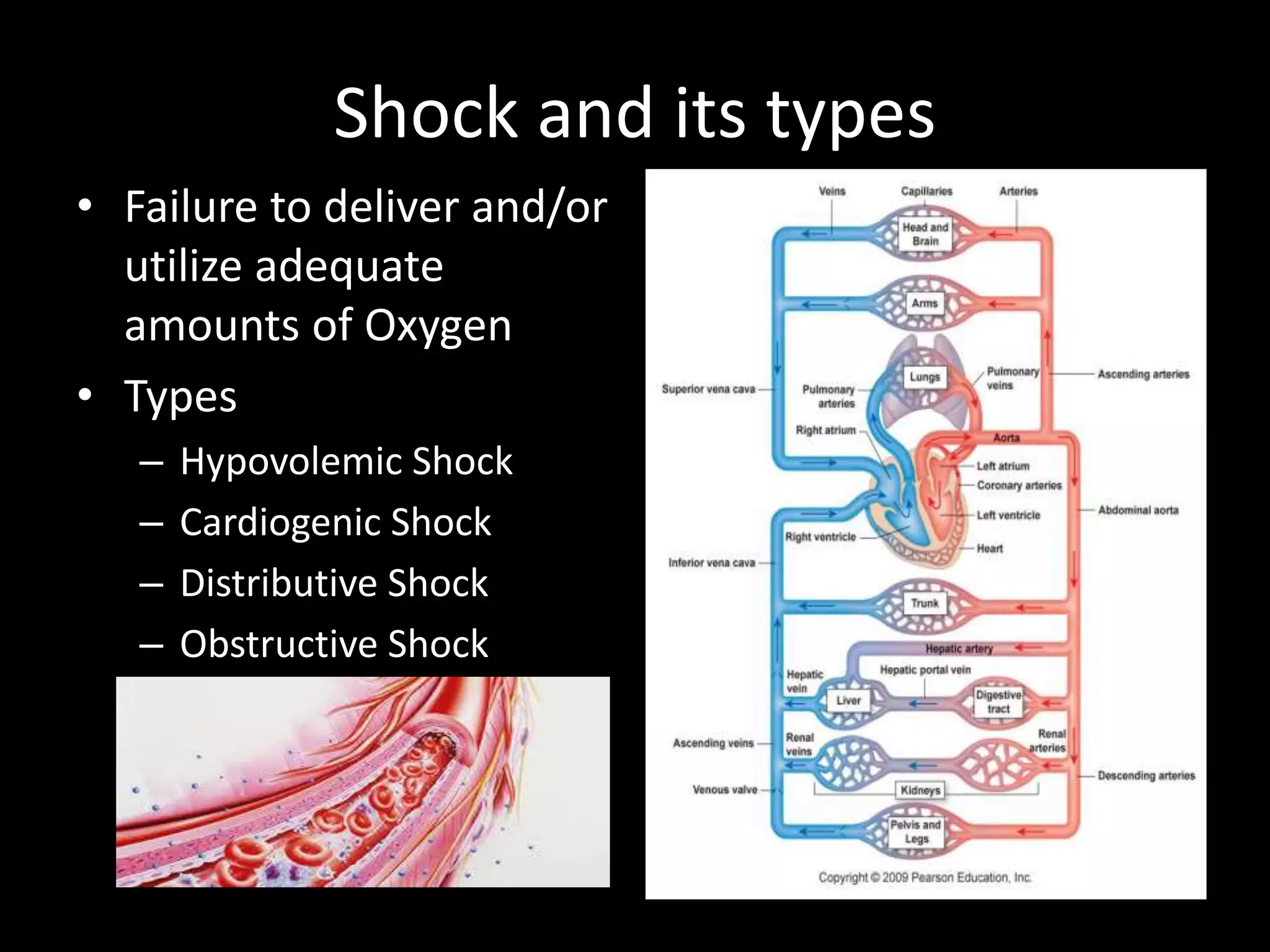 Shock and its types
• Failure to deliver and/or
utilize adequate
amounts of Oxygen
• Types
– Hypovolemic Shock
– Cardiogenic Shock
– Distributive Shock
– Obstructive Shock
 