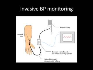 Invasive BP monitoring
 