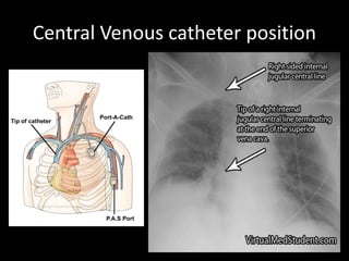 Central Venous catheter position
 