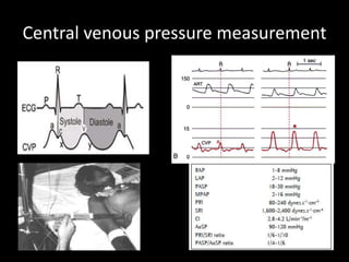 Central venous pressure measurement
 
