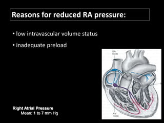Reasons for reduced RA pressure:
• low intravascular volume status
• inadequate preload
Right Atrial Pressure
Mean: 1 to 7 mm Hg
 