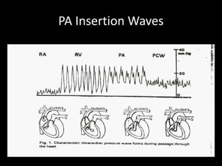 PA Insertion Waves
 