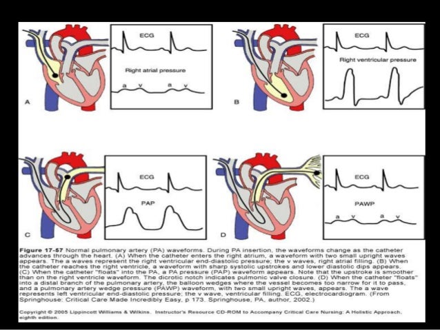 Basic Hemodynamic Monitoring For Nurses