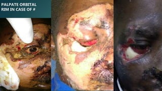 PALPATE ORBITAL
RIM IN CASE OF #
 