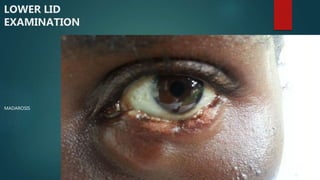 LOWER LID
EXAMINATION
MADAROSIS
 
