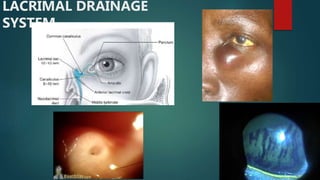 LACRIMAL DRAINAGE
SYSTEM
 