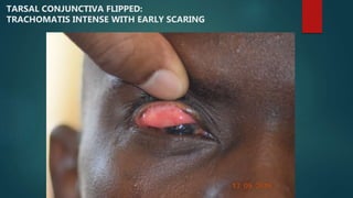 TARSAL CONJUNCTIVA FLIPPED:
TRACHOMATIS INTENSE WITH EARLY SCARING
 