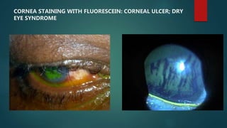 CORNEA STAINING WITH FLUORESCEIN: CORNEAL ULCER; DRY
EYE SYNDROME
 