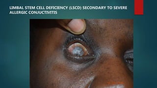 LIMBAL STEM CELL DEFICIENCY (LSCD) SECONDARY TO SEVERE
ALLERGIC CONJUCTIVITIS
 