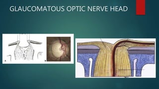 GLAUCOMATOUS OPTIC NERVE HEAD
 