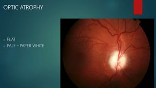 OPTIC ATROPHY
o FLAT
o PALE – PAPER WHITE
 