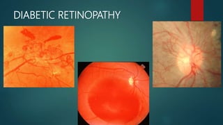 DIABETIC RETINOPATHY
 