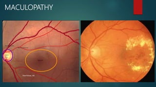 MACULOPATHY
 
