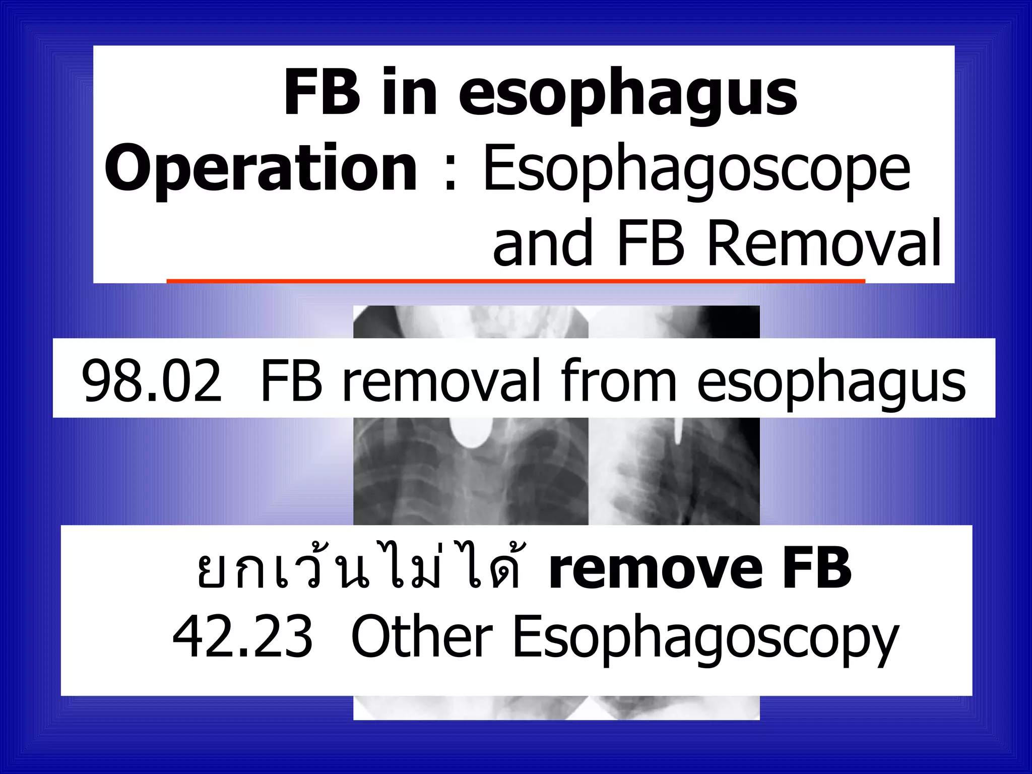 FB in esophagus
Operation : Esophagoscope
            and FB Removal

98.02 FB removal from esophagus


    ยกเว้ น ไม่ ไ ด้ remove FB
   42.23 Other Esophagoscopy
 