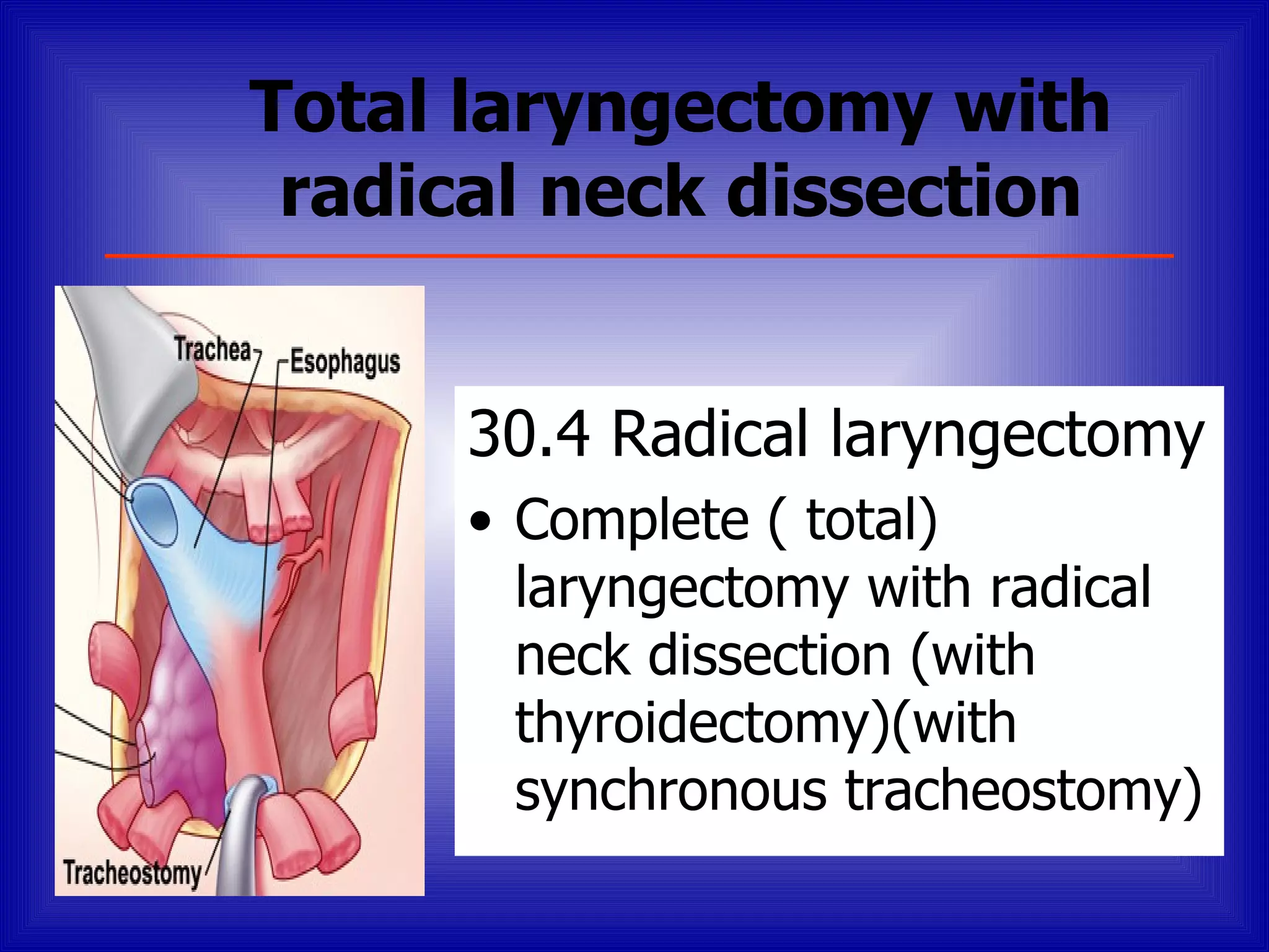 Total laryngectomy with
 radical neck dissection


      30.4 Radical laryngectomy
      • Complete ( total)
        laryngectomy with radical
        neck dissection (with
        thyroidectomy)(with
        synchronous tracheostomy)
 