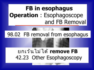 FB in esophagus
Operation : Esophagoscope
            and FB Removal

98.02 FB removal from esophagus


    ยกเว้ น ไม่ ไ ด้ remove FB
   42.23 Other Esophagoscopy
 