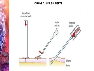 DRUG ALLERGY TESTS
 