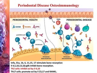 Periodontal Disease Osteoimmunology
tnfa, il1a, 1b, 6, 11,15, 17 stimulate bone resorption
Il 4,5,10,13,18,tgfb inhibit bone resorption.
Th2 cells: inhibit ocl by il 4,10
Th17 cells: promote ocl by il 23,17 and RANKL.
 