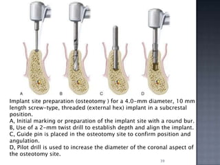 Basic Implant Surgery PPTX basic-implant-surgery-pptx