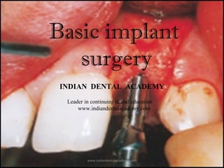 Basic implant surgery
Basic implant
surgery
INDIAN DENTAL ACADEMY
Leader in continuing dental education
www.indiandentalacademy.com
www.indiandentalacademy.com
 