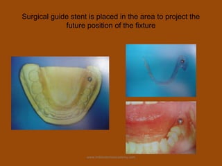 Surgical guide stent is placed in the area to project the
future position of the fixture
www.indiandentalacademy.com
 
