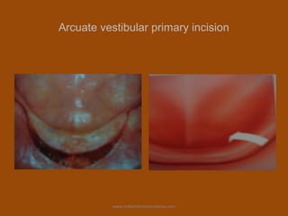Arcuate vestibular primary incision
www.indiandentalacademy.com
 