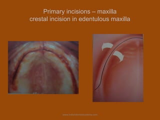 Primary incisions – maxilla
crestal incision in edentulous maxilla
www.indiandentalacademy.com
 
