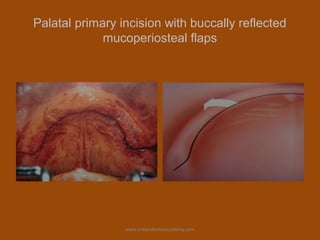 Palatal primary incision with buccally reflected
mucoperiosteal flaps
www.indiandentalacademy.com
 
