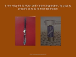 3 mm twist drill is fourth drill in bone preparation. Its used to
prepare bone to its final destination
www.indiandentalacademy.com
 
