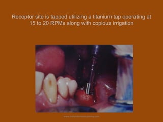 Receptor site is tapped utilizing a titanium tap operating at
15 to 20 RPMs along with copious irrigation
www.indiandentalacademy.com
 