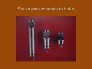 Fixture mount is connected to the implant
www.indiandentalacademy.com
 