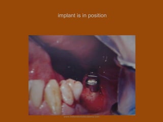 implant is in position
www.indiandentalacademy.com
 