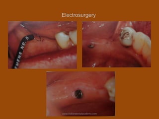 Electrosurgery
www.indiandentalacademy.com
 