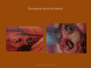 Excessive bone formation
www.indiandentalacademy.com
 
